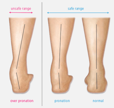 Chronic Foot Pronation – Health Bounce Rebounder